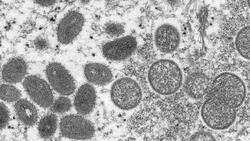 英国将猴痘列为法定应报告的传染病  